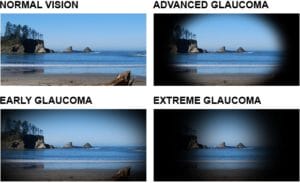 Glaucoma vision images