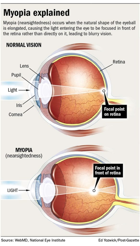 Prevent Myopia in Children Eyecare Associates of Lee’s Summit