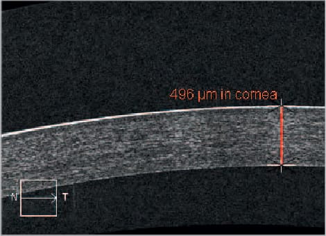corneal thickness
