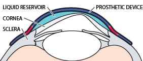How Scleral Lenses Treat Dry Eye Disease