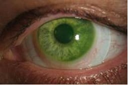 scleral lens eye comfort