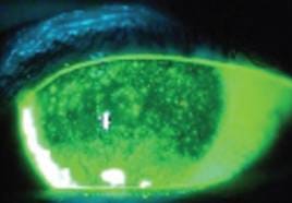 chronic ocular GVHD