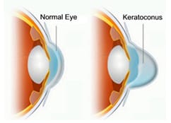 keratoconus