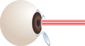 lasik