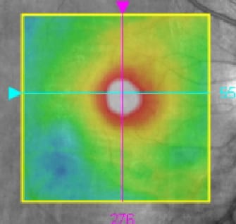 retinal thickness
