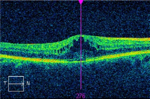 retinal thickness