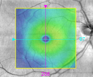OCT macular scan normal 2019 - color map