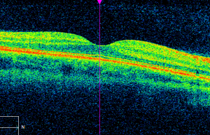 OCT macular scan normal 2019 - cross section
