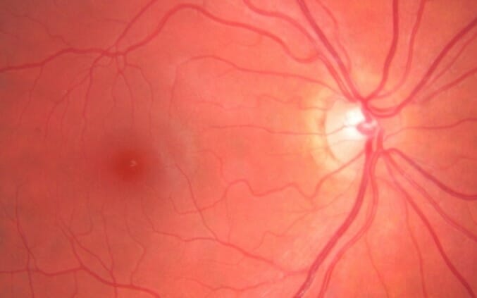 Image of healthy retina without disease.