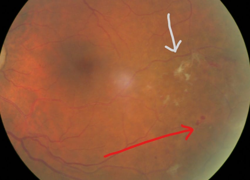 diabetic retinopathy