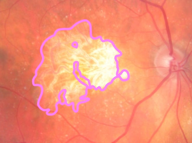 Image of severe geographic atrophic which small islands of surveying tissue. This person will have poor vision.