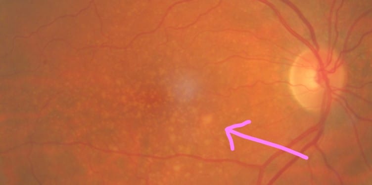 Image of moderate macular degeneration with scattered drusen and macular pigment changes.