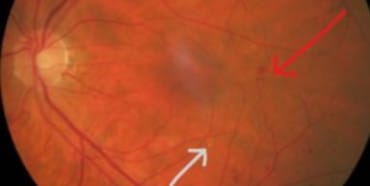 Diabetic Eye Disease