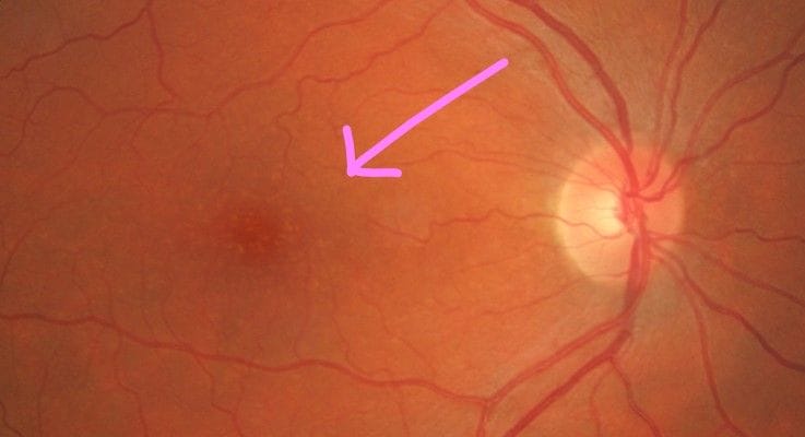 Macular Degeneration